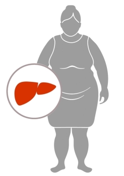 “B형간염 환자, 비만에 주의해야…간암위험 30% 더 높아“