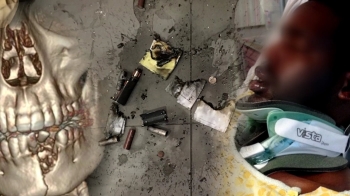 전자담배 또 폭발…미 고교생, 턱뼈·치아 부서져 중상