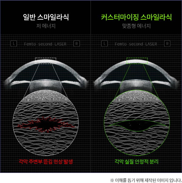 스마일라식회복 기간을 줄이기 위해