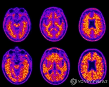 “치매 연구 국가가 주도한다“…9년간 R&D 2천억 투입