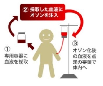 '혈액 클렌징이 암·노화예방?'…일본서 효과 논란