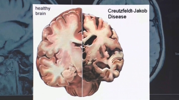 [단독] 올 들어 20대 CJD 의심환자 2명 확인…“변종 여부 조사“