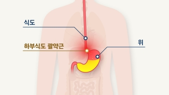 '국민 질환' 역류성 식도염 유발하는 위험한 습관은?｜민혜연 가정의학과 전문의 [상클라이프]