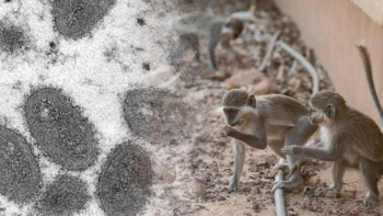 미국 텍사스서 원숭이두창 감염 환자 숨져…“사인 확인 중“