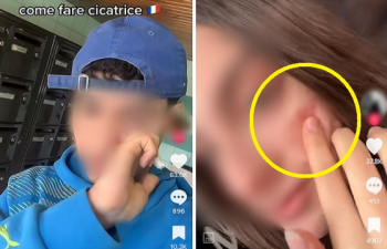 이탈리아 10대들의 위험한 유행…'얼굴 흉터내기'에 당국, 틱톡 조사