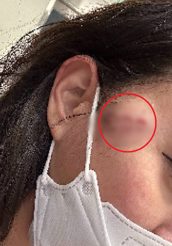 20대 여성 유튜버가 오늘(5일) 경기도 부천시 부천역 인근 거리에서 30대 동료 유튜버에게 포크를 휘둘러 얼굴을 다치게 한 혐의를 받고 있다. 피해자가 올린 사진. 〈사진=피해자 유튜브 캡처〉