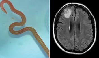 머리 속에서 '꿈틀꿈틀'…환자 뇌에서 살아있는 회충 발견